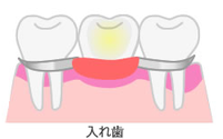 入れ歯