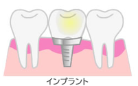インプラント