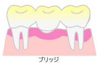 ブリッジ